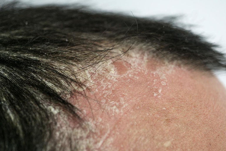 Những dải thương tổn bằng với mặt da, trên bề mặt thương tổn có vảy da mỏng, giới hạn rõ với vùng da lành còn lại